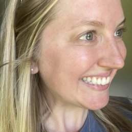 One week later, Botox by Brittany One week later, Botox by Brittany