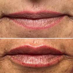 Family Crown Dentistry - Lip filler