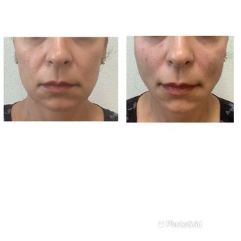Bella Sol Med Spa - Notice 1st pic, round jowls and deeper nasolabial folds, 2nd pic; a more prominent V-shaped jowl line and softened nasolabial folds - Medical Spas Near Me - Chino, California