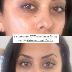 Dreemy Aesthetics - Top Photo is before Bottom is after treatment Insane progress