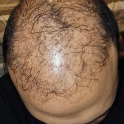 Hair Restoration Specialists of Atlanta