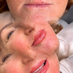 Stunning Skin By Kim - Redefining lip shape w permanent lips