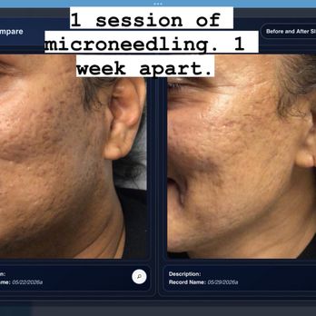 Complexions RX - Microneedling before and after - Skin Care Near Me - San Diego, California Complexions RX - Microneedling before and after - Skin Care Near Me - San Diego, California