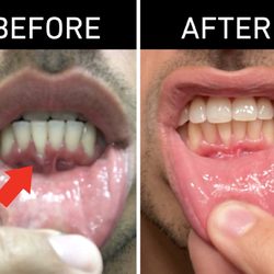 Kevin K Lee, DDS - Gum grafting before and after. Gum was separated from tooth in before photo.