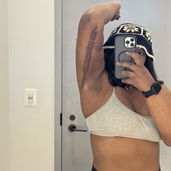 Bella Cosmetic Surgery - Scar