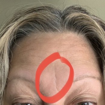 Beverly Hills Plastic Surgery Group - About 30 seconds after application of the Beverly Hills Deep Wrinkle Filler. No other product or makeup, and I didn't put it anywhere else. - Cosmetic Surgeons Near Me - Beverly Hills, California