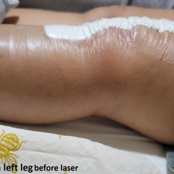 Milestones Movement Therapy - Post-op Day 2: Swollen left leg before laser treatment with Miles - Trainers Near Me - Davis, California Milestones Movement Therapy - Post-op Day 2: Swollen left leg before laser treatment with Miles - Trainers Near Me - Davis, California