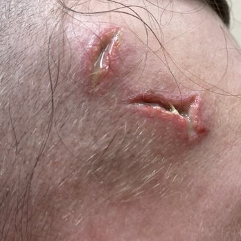 Natividad Medical Center - Forehead unstitched and infected - Medical Centers Near Me - Salinas, California Natividad Medical Center - Forehead unstitched and infected - Medical Centers Near Me - Salinas, California