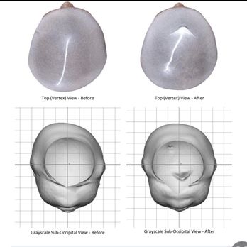 Cranial Technologies - Imaging of head shape Before (left) and after (right) - Medical Centers Near Me - Pasadena, California Cranial Technologies - Imaging of head shape Before (left) and after (right) - Medical Centers Near Me - Pasadena, California