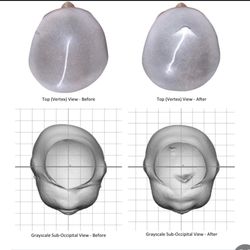 Cranial Technologies - Imaging of head shape Before (left) and after (right)