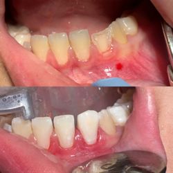 Little Smiles of Beverly Hills - If you ever have an accident and chip a tooth, please try to preserve the broken piece... we may be able to place in back together.