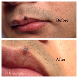 Mole removal performed by Dr. Vigilia four weeks after surgery Mole removal performed by Dr. Vigilia four weeks after surgery