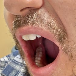 Hudec Dental - Root canal