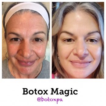 Visage Boutique Oak Park - Forehead and crow's, glabella post-Xeomin results. - Medical Spas Near Me - Oak Park, Illinois Visage Boutique Oak Park - Forehead and crow's, glabella post-Xeomin results. - Medical Spas Near Me - Oak Park, Illinois
