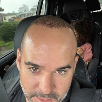 TJ Hair System - 4 days later - Hair Loss Centers Near Me - Tijuana, BCN TJ Hair System - 4 days later - Hair Loss Centers Near Me - Tijuana, BCN