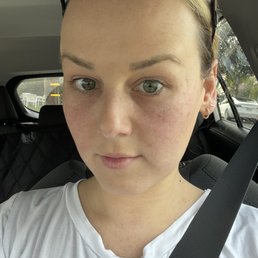 After under eye PRF gel After under eye PRF gel