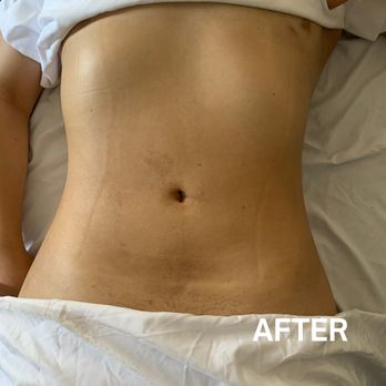 The Detox Lounge - 3 weeks post op healing with lymphatic drainage - Massage Therapy Near Me - Orange, California The Detox Lounge - 3 weeks post op healing with lymphatic drainage - Massage Therapy Near Me - Orange, California