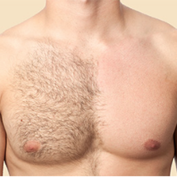 Sunset MedSpa - laser hair removal with alma soprano ICE - Medical Spas Near Me - Beaverton, Oregon Sunset MedSpa - laser hair removal with alma soprano ICE - Medical Spas Near Me - Beaverton, Oregon