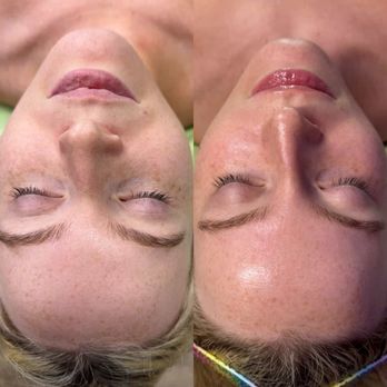 Alchemy Skin - Acne Treatment Near Me - Plano, Texas Alchemy Skin - Acne Treatment Near Me - Plano, Texas