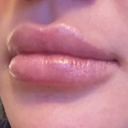 Lip Filler Lip Filler