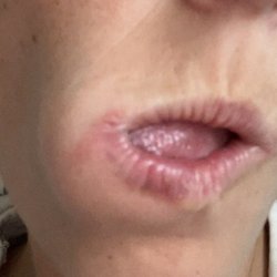 Sun Valley Skin Center - Rash on mouth