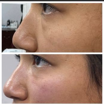 Skin Addiction and Health Care - Under eye filler - Medical Spas Near Me - Bothell, Washington Skin Addiction and Health Care - Under eye filler - Medical Spas Near Me - Bothell, Washington