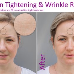 LaserHere - Laser Skin Tightening Services
