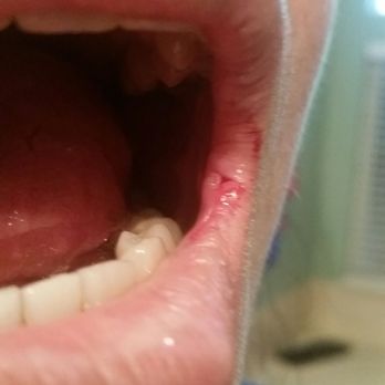Modesto Smiles Dentistry - The dentist was busy socializing and put a hole at the end of my wife's lip. - General Dentistry Near Me - Modesto, California Modesto Smiles Dentistry - The dentist was busy socializing and put a hole at the end of my wife's lip. - General Dentistry Near Me - Modesto, California