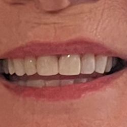 Portland Dental Works - This is the terrible result of trusting Afshar. Having them fixed on my nickel as he refused.