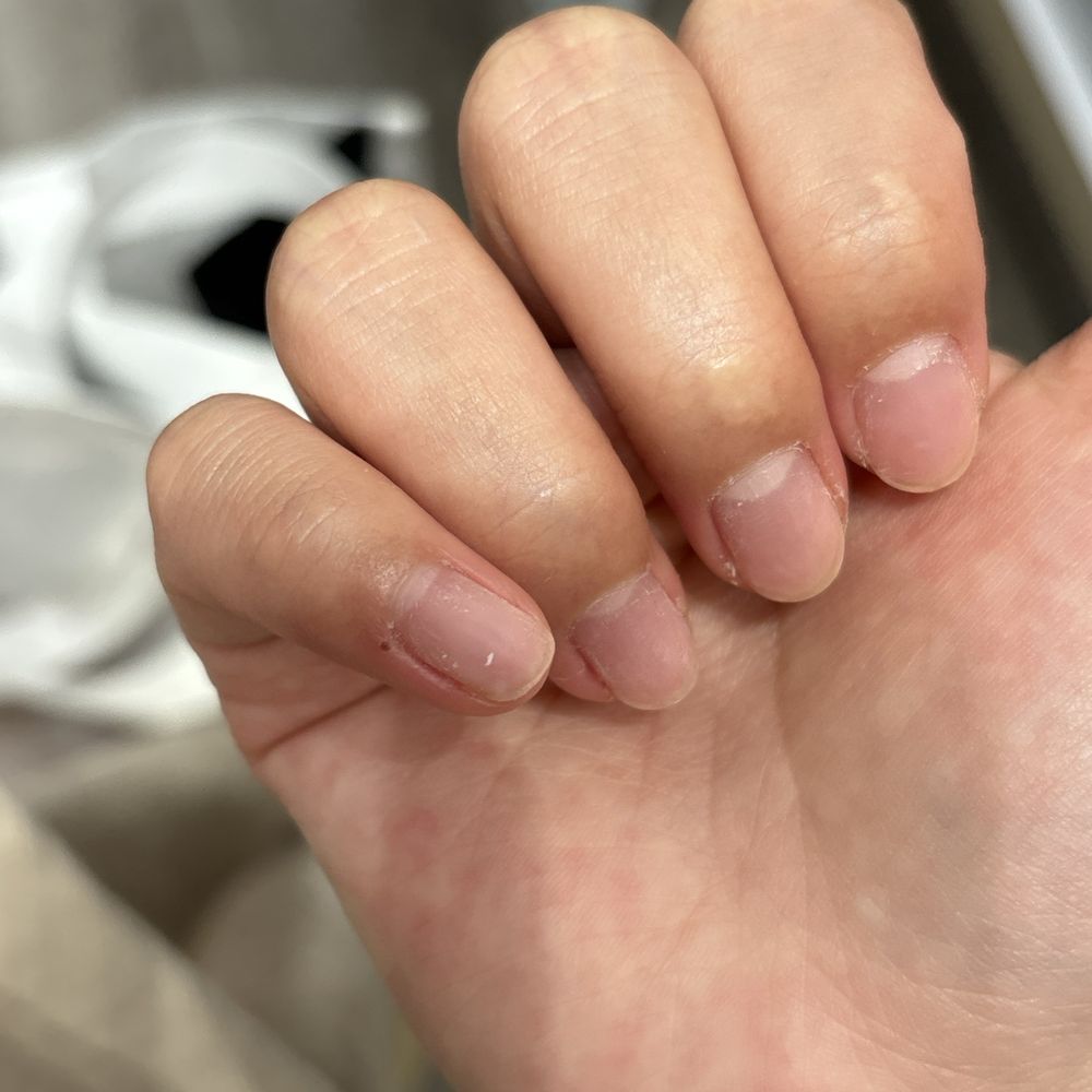 Gel removal