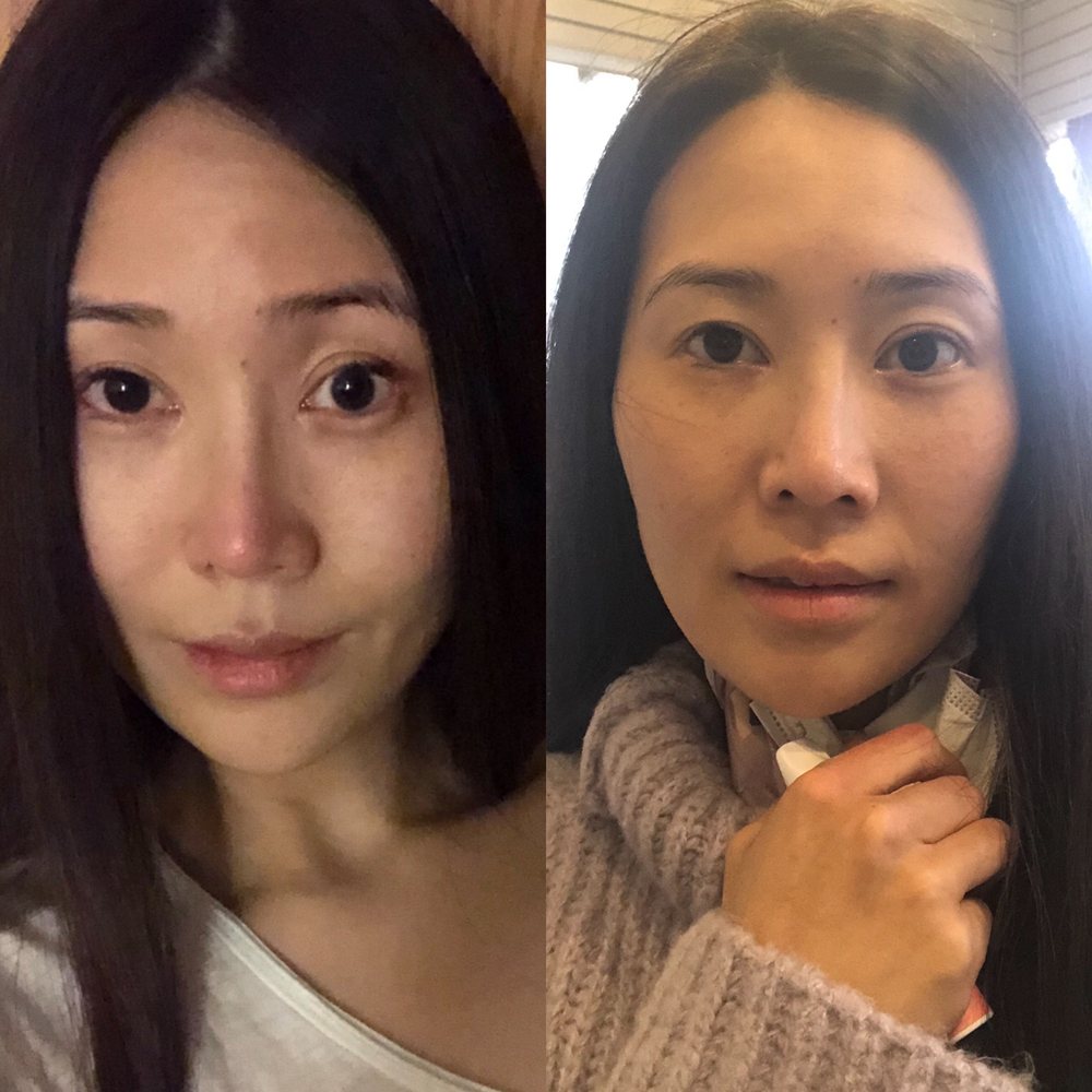 RM Skincare - Before and after "hydra facial" from what they said I did apparently - my face is much rounder and chin is not pointy - Skin Care Near Me - Flushing, New York RM Skincare - Before and after "hydra facial" from what they said I did apparently - my face is much rounder and chin is not pointy - Skin Care Near Me - Flushing, New York