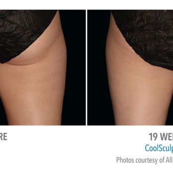 Aloha Nani Kino Spa - Coolsculpting on thighs - Medical Spas Near Me Aloha Nani Kino Spa - Coolsculpting on thighs - Medical Spas Near Me