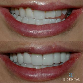 JJ Dental - General Dentistry Near Me - Pompano Beach, Florida JJ Dental - General Dentistry Near Me - Pompano Beach, Florida