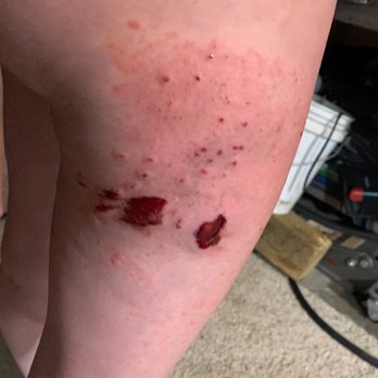 MinuteClinic at CVS - Burns from 7/4/20 fireworks accident! Fresh burns - Walk-in Clinics Near Me - LAWRENCEVILLE, Georgia MinuteClinic at CVS - Burns from 7/4/20 fireworks accident! Fresh burns - Walk-in Clinics Near Me - LAWRENCEVILLE, Georgia