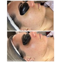 Enhancing Esthetics - Anti-aging facial with a dermaplane add on. Top before, bottom after pic.