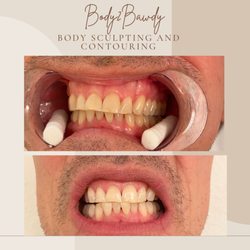 Teeth Whitening Service