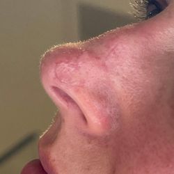 Ali Hendi, MD - 3.5 weeks post op healing. Very pleased!