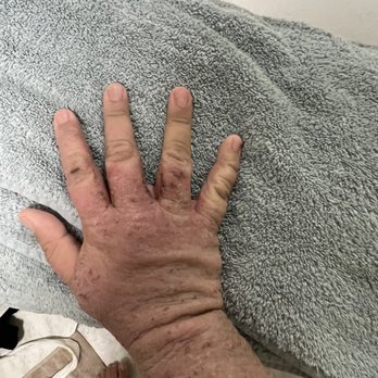 Natural Healing Center - Between fingers oozing liquid but overall dry - Naturopathic/Holistic Near Me - Newport Beach, California Natural Healing Center - Between fingers oozing liquid but overall dry - Naturopathic/Holistic Near Me - Newport Beach, California