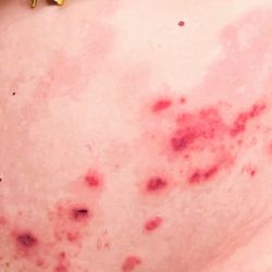 Verde Valley Medical Center - SEVERE CASE OF SHINGLES