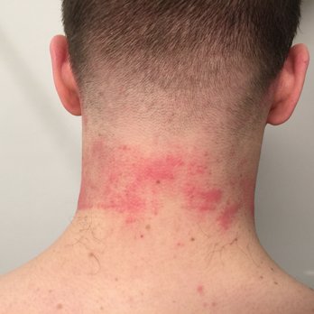 Calabro's Finest Cuts - This is over 8 hours after the haircut and after I had already treated all the cuts. So much bleeding also around my sideburns and forehead. - Barbers Near Me - Braintree, Massachusetts