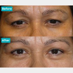 Christopher C. Lo, MD - Los Angeles - This patient underwent an upper blepharoplasty by Dr. Lo for a more youthful and rejuvenated appearance