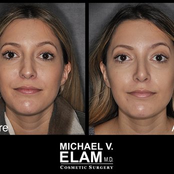 1. Michael V Elam, MD