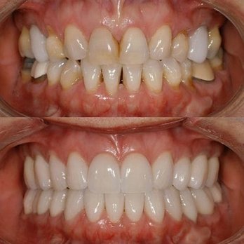 Prabhsharan Sandhu, DDS - before and after - General Dentistry Near Me - Phoenix, Arizona Prabhsharan Sandhu, DDS - before and after - General Dentistry Near Me - Phoenix, Arizona