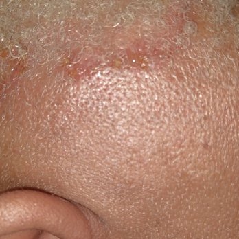 Beauty Concepts - Chemical burn left side. - Hair Stylists Near Me - Woodland, California Beauty Concepts - Chemical burn left side. - Hair Stylists Near Me - Woodland, California