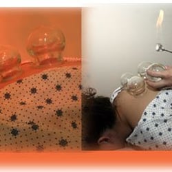 Shen Shen Health & Harmony - Cupping
