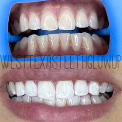 West Texas Teeth Glow Up