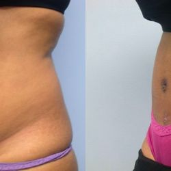 Millennium Medical: Dr. Rassael - Before & After from Millennium Medical: Dr. Rassael | Chevy Chase, MD