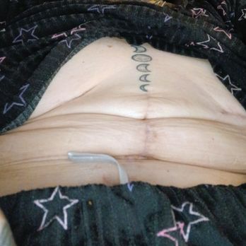 Zoe Plastic Surgery - Tons of rolls after reconstructive surgery - Plastic Surgeons Near Me - Miami, Florida