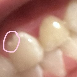 Just For Grins Kids and Family Dental and Orthodontics - Chipped tooth caused by inexperienced drill usage and tooth with enamel drilled off giving yellow appearance.