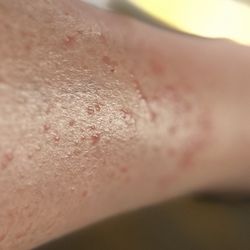 Clarion Hotel - My legs bitten with flea bites.